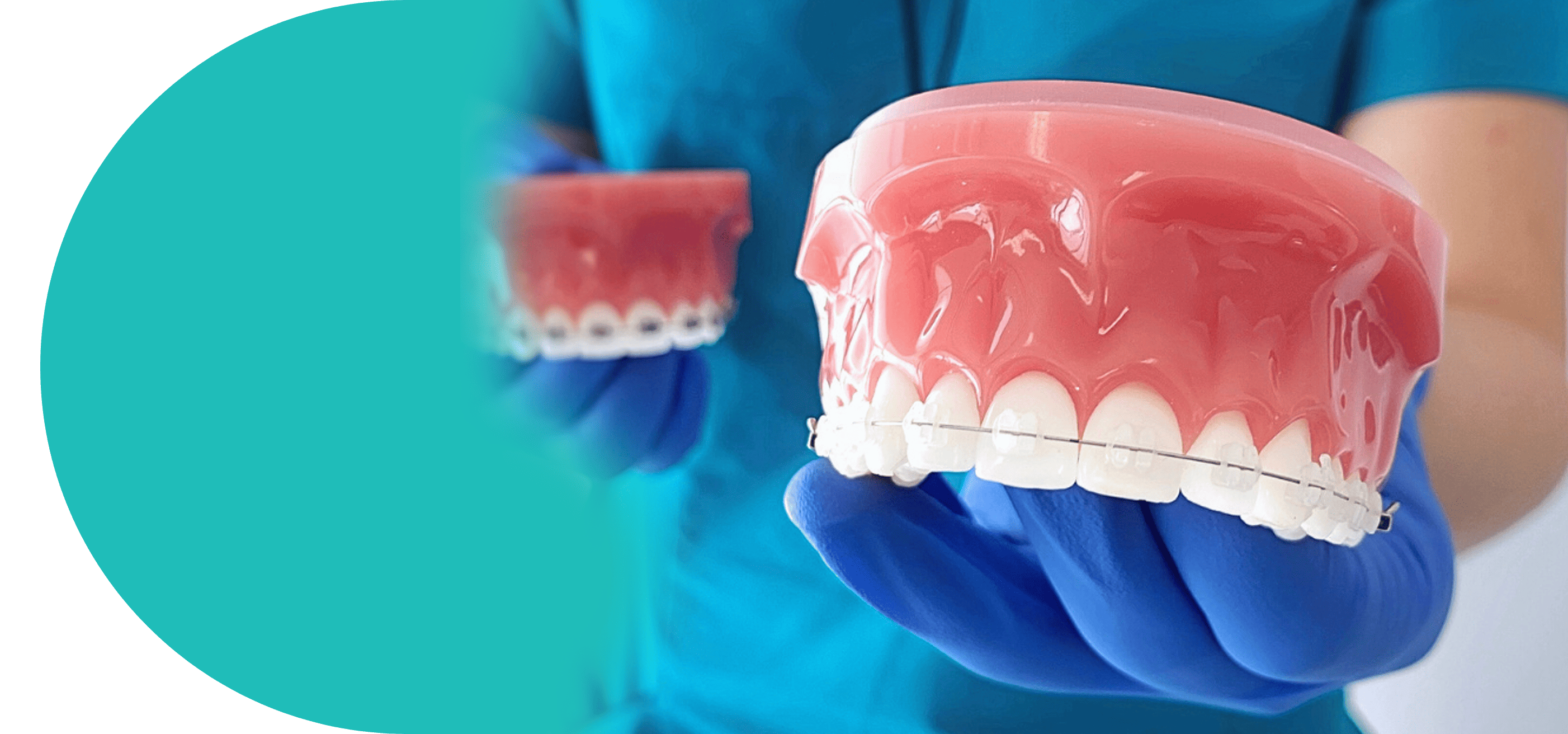 ceramic-braces