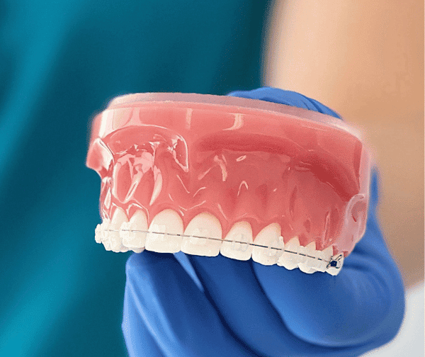 Ceramic Clear Braces Penrith